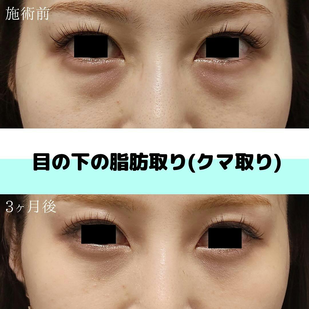 【女性・目元】目の下の脂肪取り(クマ取り)_before_aftar