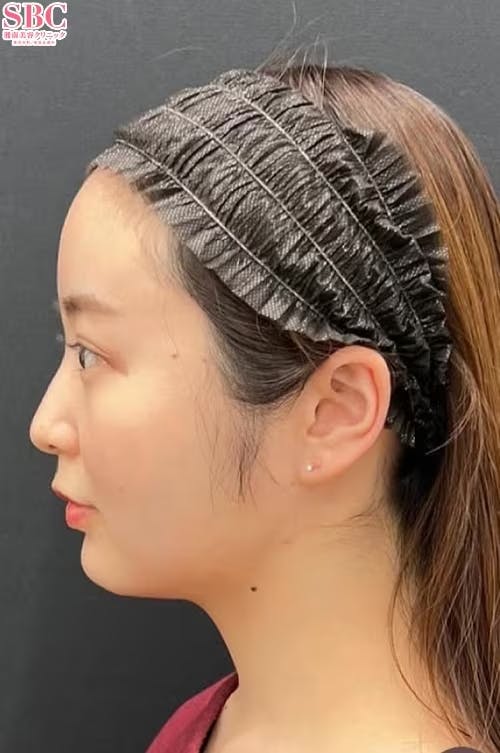 【女性・顔】Aquicell（アキーセル）脂肪吸引、根こそぎVASER脂肪吸引、糸リフト、エンブレイスRF_after