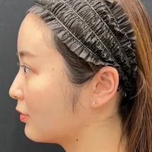 【女性・顔】Aquicell(アキーセル)脂肪吸引、根こそぎVASER脂肪吸引、糸リフト、エンブレイスRF_after