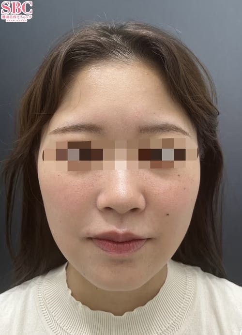 【女性・顔】美ボディ脂肪吸引、メーラーファット除去術、ボトックス_after