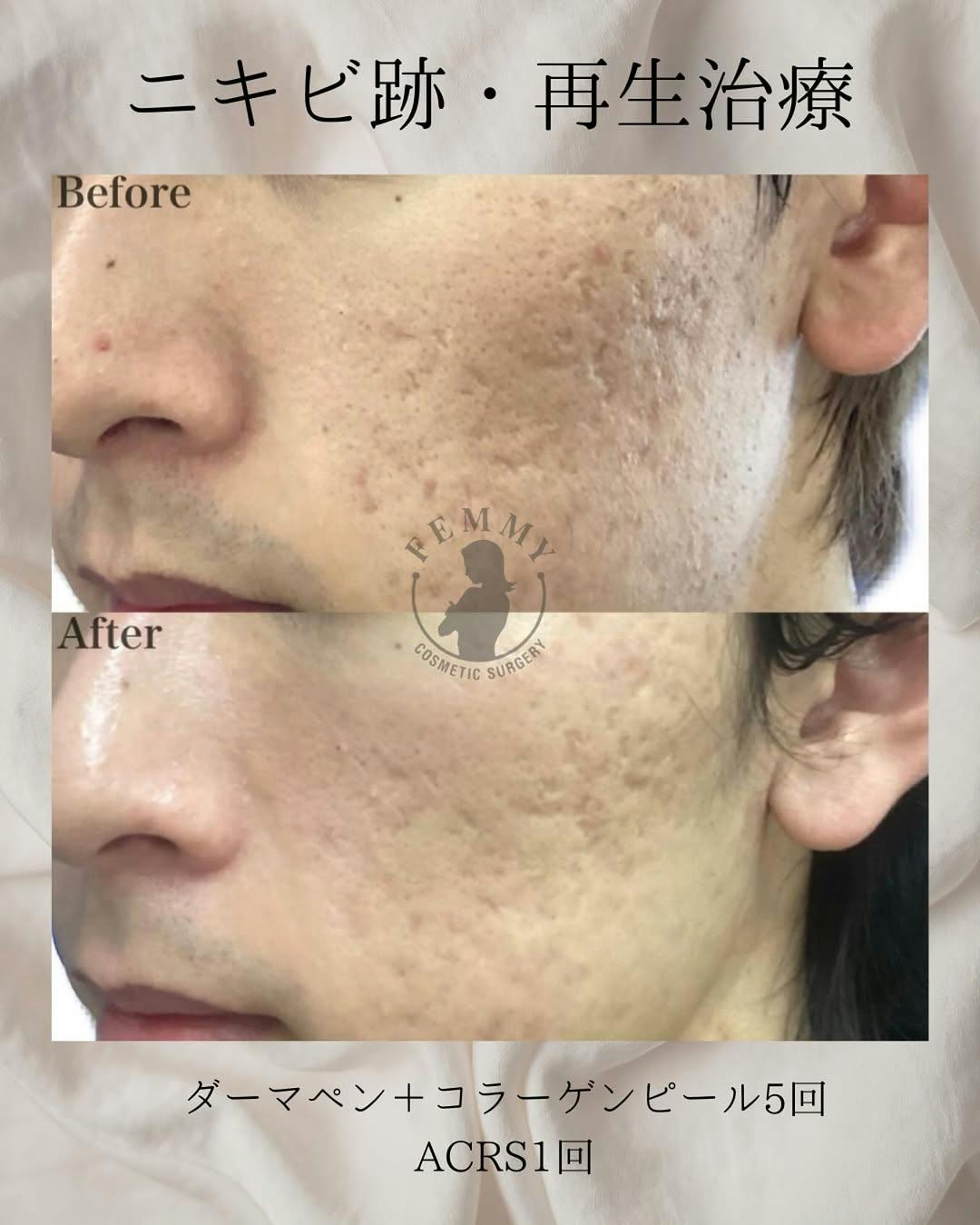 【男性・ニキビ跡】ダーマペンコラーゲンピール・ACRS_before_aftar