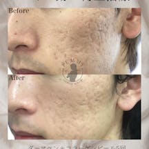 【男性・ニキビ跡】ダーマペンコラーゲンピール・ACRS_before_aftar