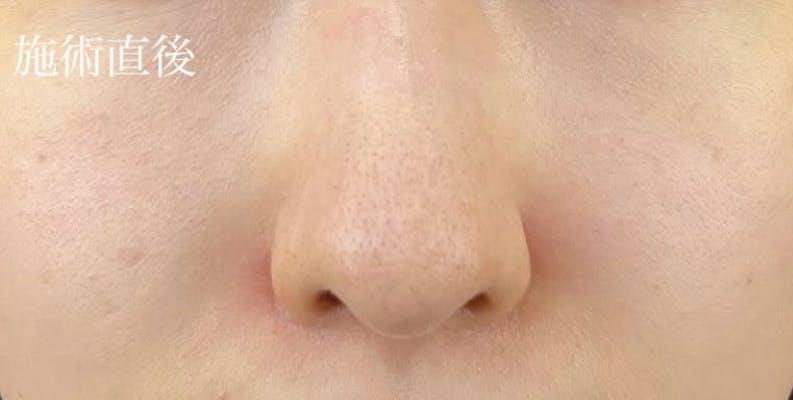 マイプレイスビューティークリニック(my place beauty clinic)でヒアルロン酸注射・注入を受けたサンドモフさんの写真