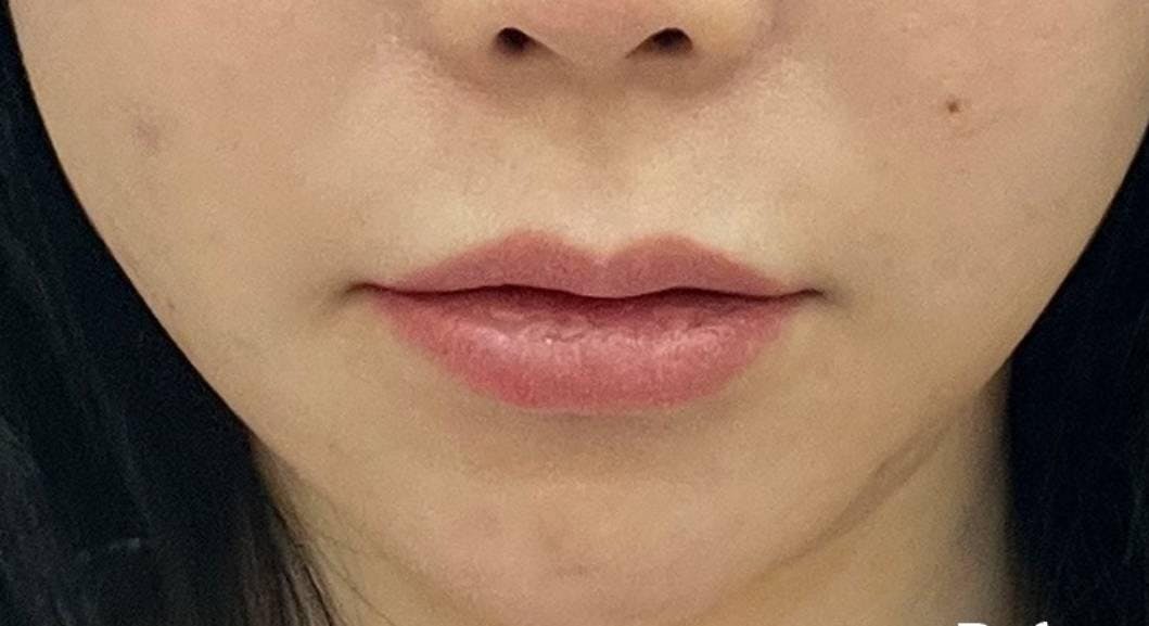 湘南美容クリニック 横浜院でヒアルロン酸注入：口元ヒアルロン酸注入（ジュビダームビスタ ボルベラXC）を受けたYOMIさんの写真