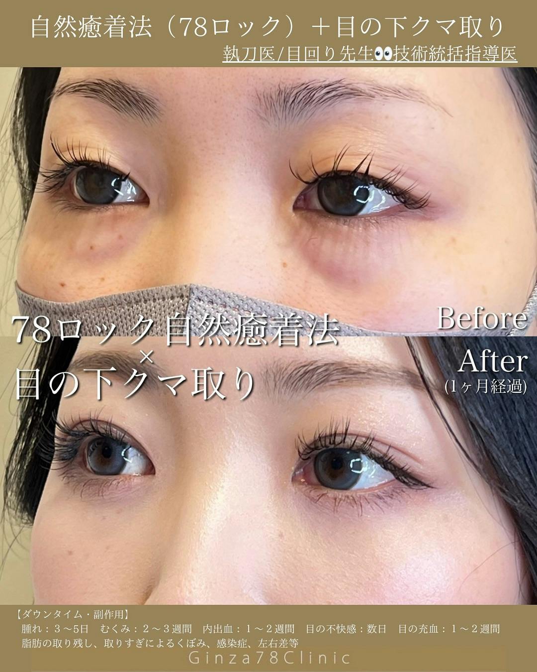 【女性・目元】目の下のクマ取り・二重埋没自然癒着法(78ロック)_before_aftar