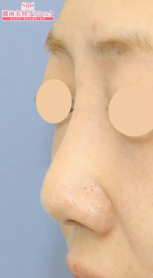 【女性・鼻】SBCプレミアムソフトプロテーゼ_aftar