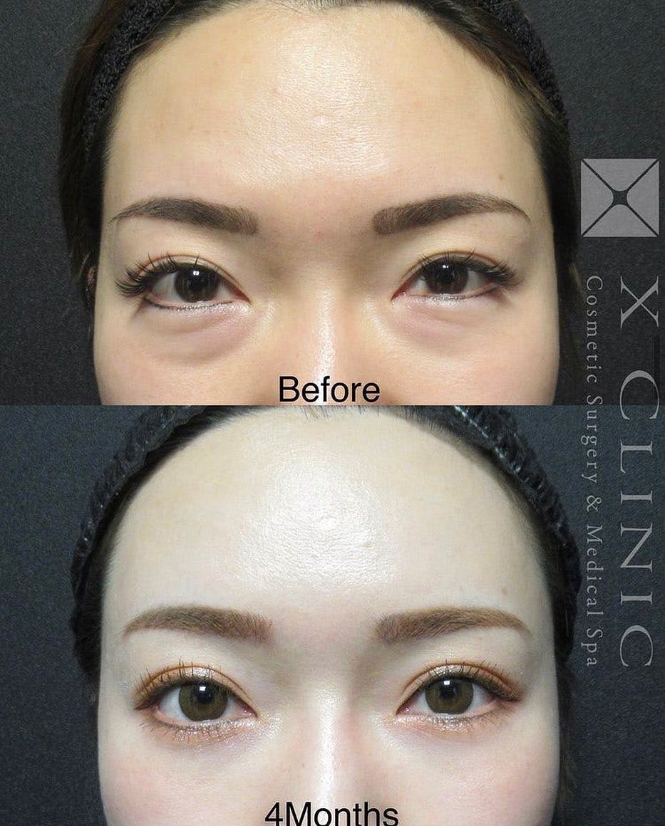 【女性・目元】クマ取りフルコース 額こめかみ脂肪注入_before_aftar