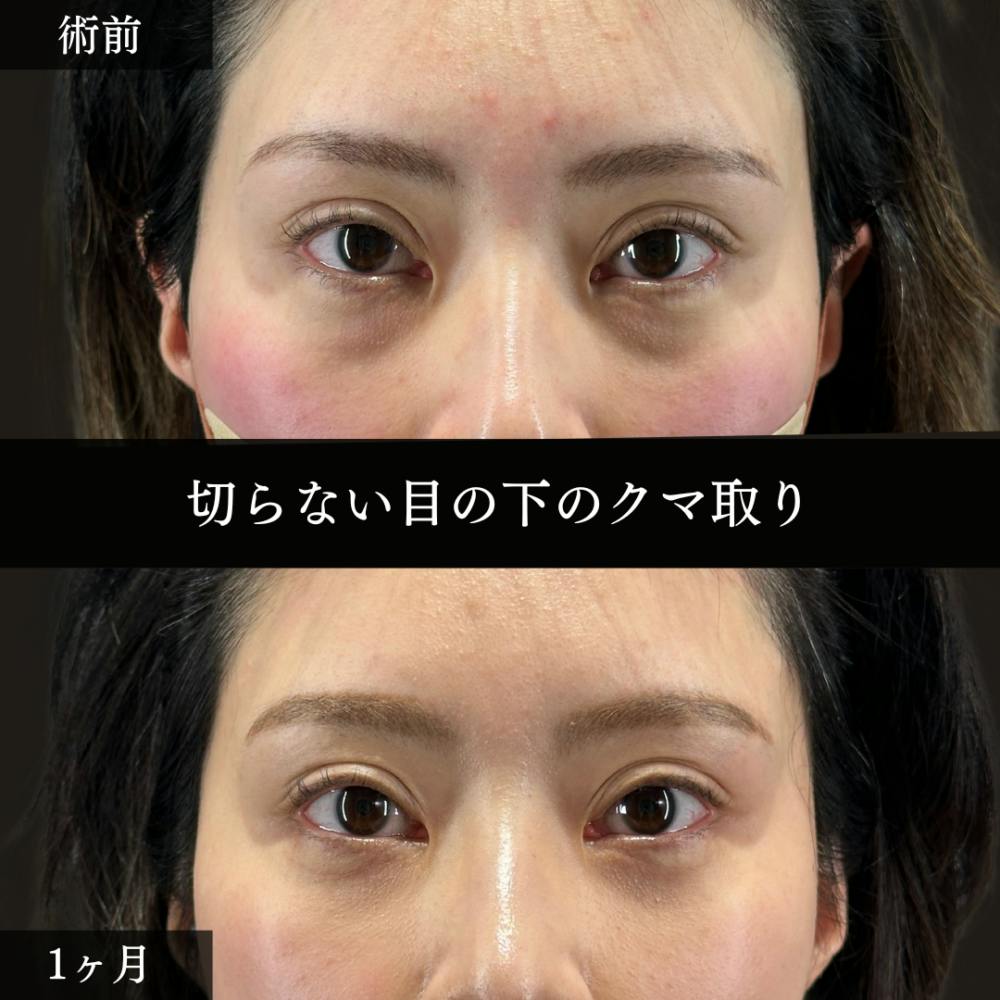 【40代女性・目】切らない目の下のクマ取り_before_aftar