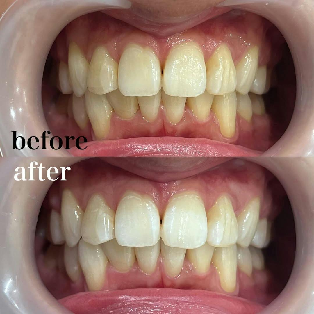 【歯】ペインレスコース_before_aftar