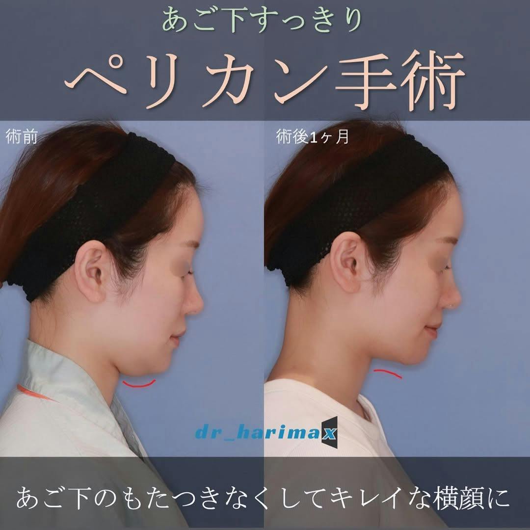 【女性・顎下】ペリカン手術_before_aftar
