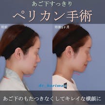 【女性・顎下】ペリカン手術_before_aftar