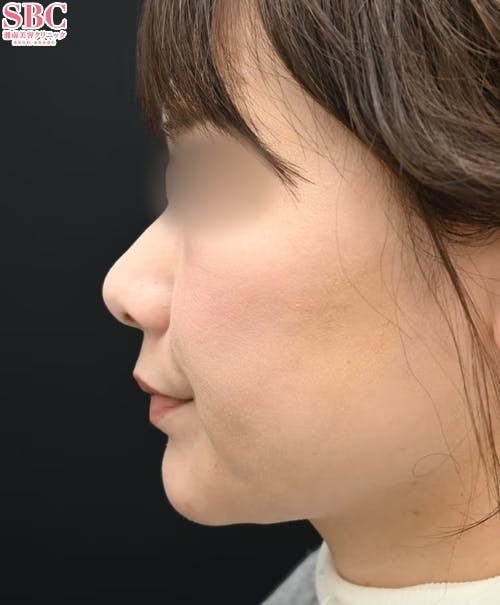 【女性・輪郭】ヒアルロン酸_after