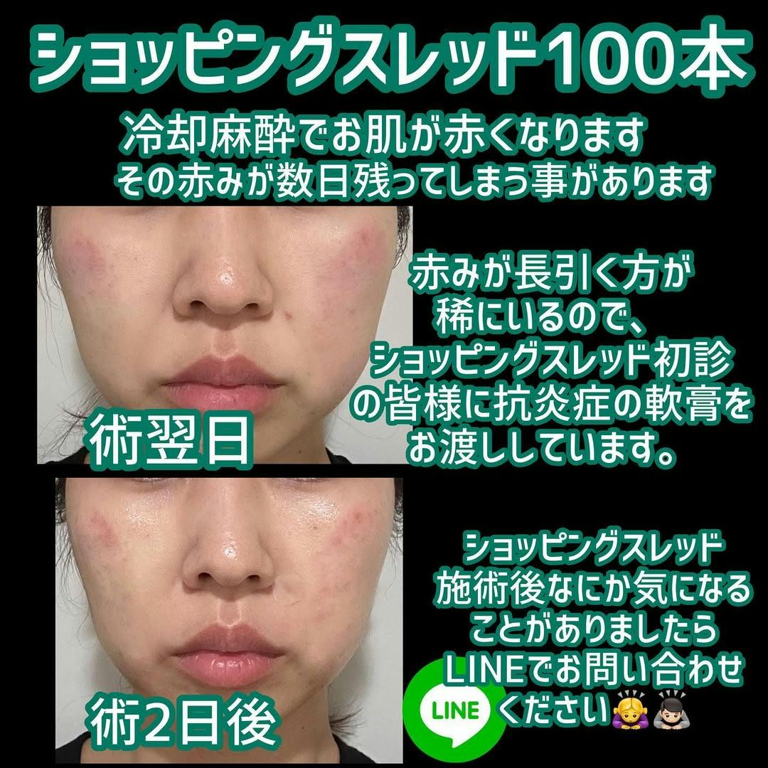 【女性・輪郭】ショッピングスレッド100本_before_aftar