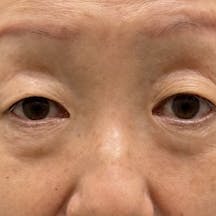 【50代女性・目元】ナチュラル脂肪注射コンデンスリッチ 目の下の切らないクマ・たるみ(ふくらみ)取り コンデンスリッチフェイス脂肪注入全顔入れ放題_before