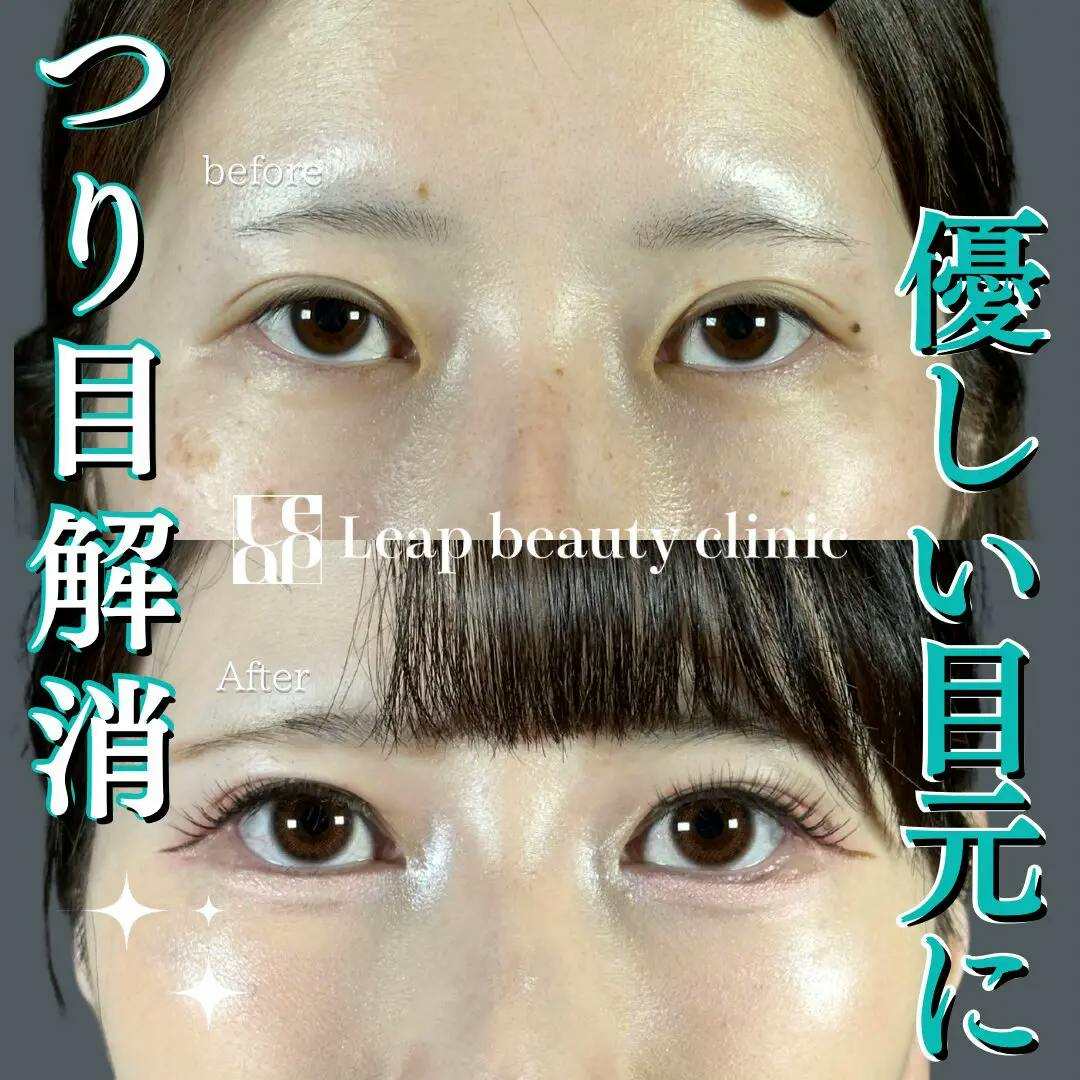 【20代女性・目元】目頭切開・目尻切開・グラマラスライン切開法_before_aftar