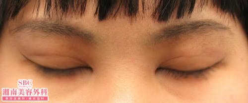 【女性・目元】クイックコスメティーク・ダブルNeo・クイックコスメティーク・シングルNeo・目頭切開プレミアム_aftar