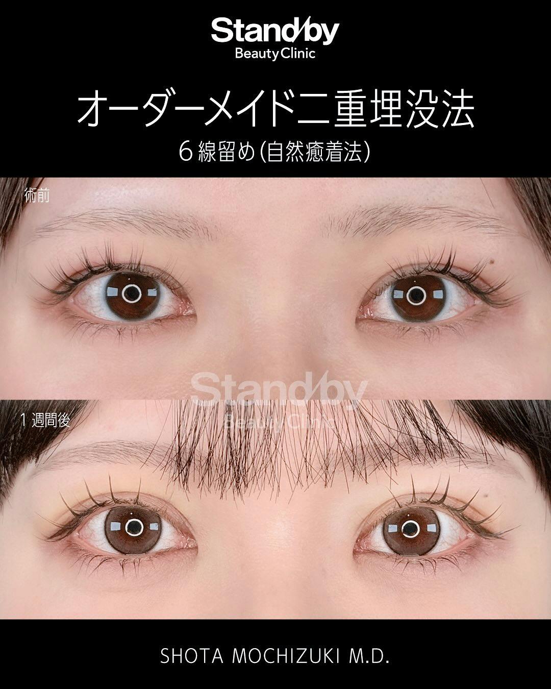 【女性・目元】オーダーメイド二重埋没法　6線留め(自然癒着法)_before_aftar