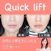 【女性・小顔】クイックリフト、エラボトックス、ヒアルロン酸(顎)_before_aftar