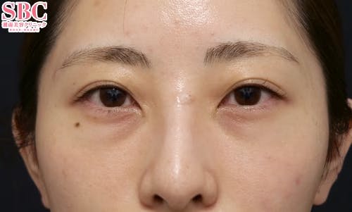 【20代女性・クマ】目の下の切らないクマ・たるみ（ふくらみ）取り ナチュラル脂肪注射コンデンスリッチ_before