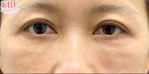 【40代女性・目元】裏ハムラ法 SBCプレミアムPRP皮膚再生療法_10days