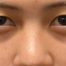 【20代女性・目元】目の下の切らないクマ・たるみ(ふくらみ)取り ナチュラル脂肪注射コンデンスリッチ ナチュラル脂肪注射ナノリッチ_before