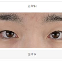 【目元】クイックコスメティーク・ダブルNeo SBC『デカ目』術_before