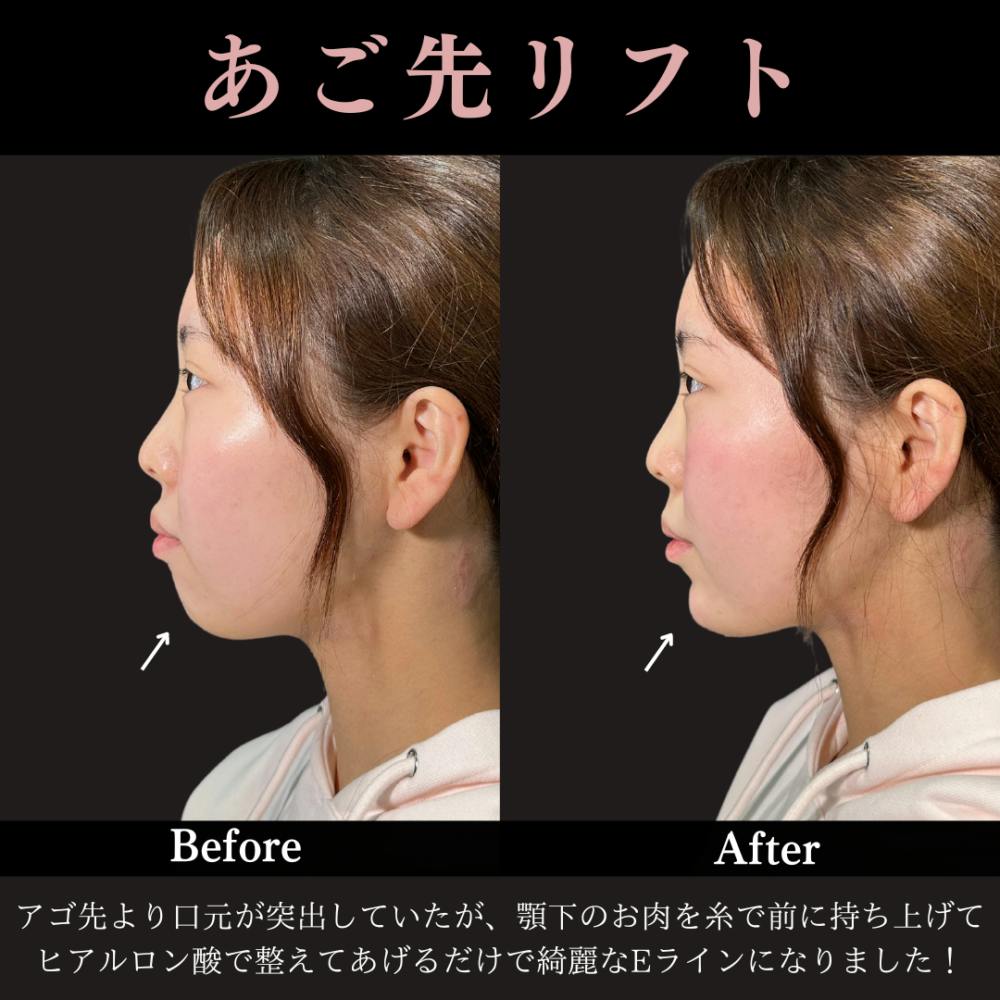 【20代女性・顎】あご先リフト＋ ヒアルロン酸（顎）_before_aftar