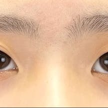 【10代女性・目元】クイックコスメティーク・ダブルNeo_before