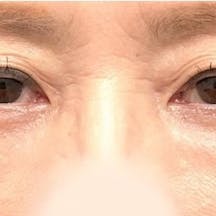 【女性・クマ】目の下の切らないクマ・たるみ(ふくらみ)取り ナチュラル脂肪注射コンデンスリッチ ナチュラル脂肪注射ナノリッチ_aftar