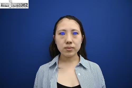 【24歳女性・小顔】バッカルファット_before