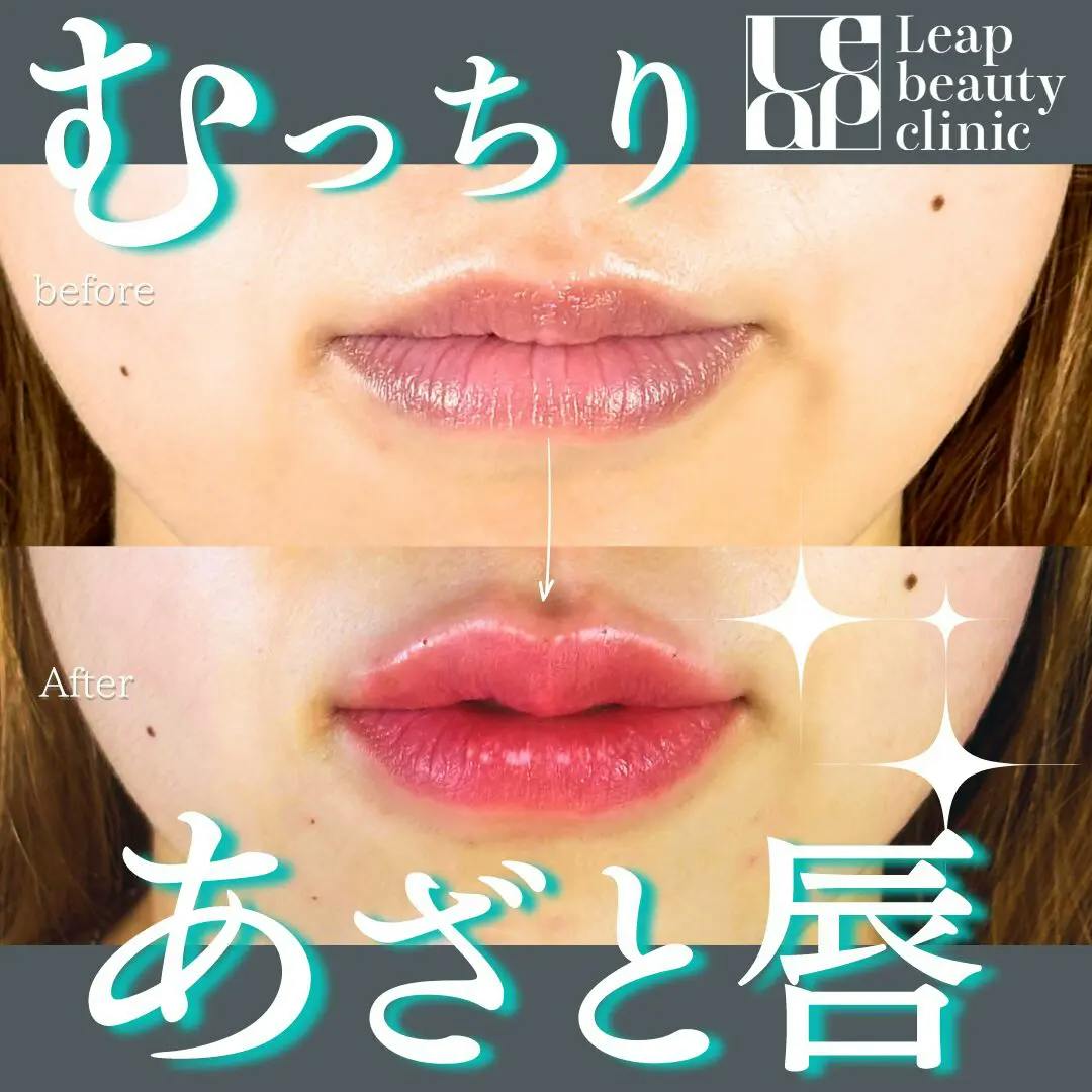 【20代女性・唇】唇ヒアルロン酸_before_aftar