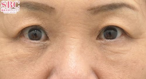 【60代女性・目元】アイバックリムーブ法、ナチュラル脂肪注射コンデンスリッチ、ナチュラル脂肪注射ナノリッチ_after