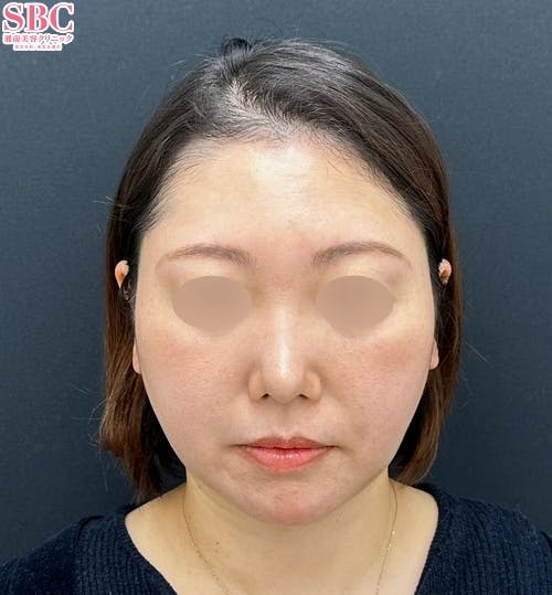 【30代女性・顔】Aquicell(アキーセル)脂肪吸引(頬・顎下)・ジョールファット除去術・メーラーファット・バッカルファット・糸リフト・エンブレイスRF・脂肪注入(顎先)_after