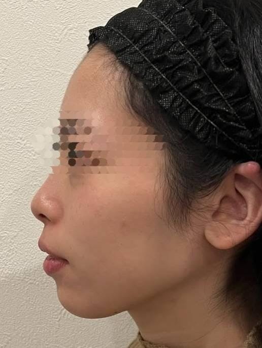 聖心美容クリニック 銀座院で鼻の整形：鼻尖縮小を受けたつー子さんの写真