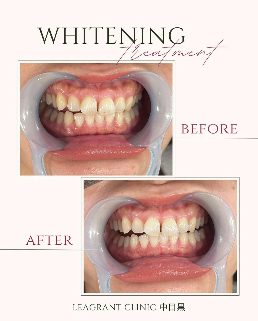 【40代女性・歯】ポリリンホワイトニング_before_aftar