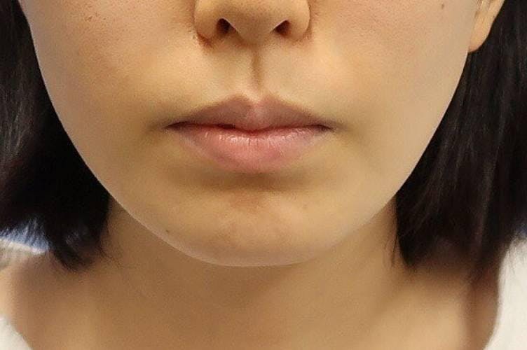 みずほクリニックで耳・耳たぶの整形：立ち耳整形（立ち耳にする整形術）を受けたかー。さんの写真