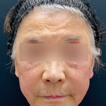 【女性・たるみ】テスリフト、VOV(ボブ)リフト、シークレットリフト_before