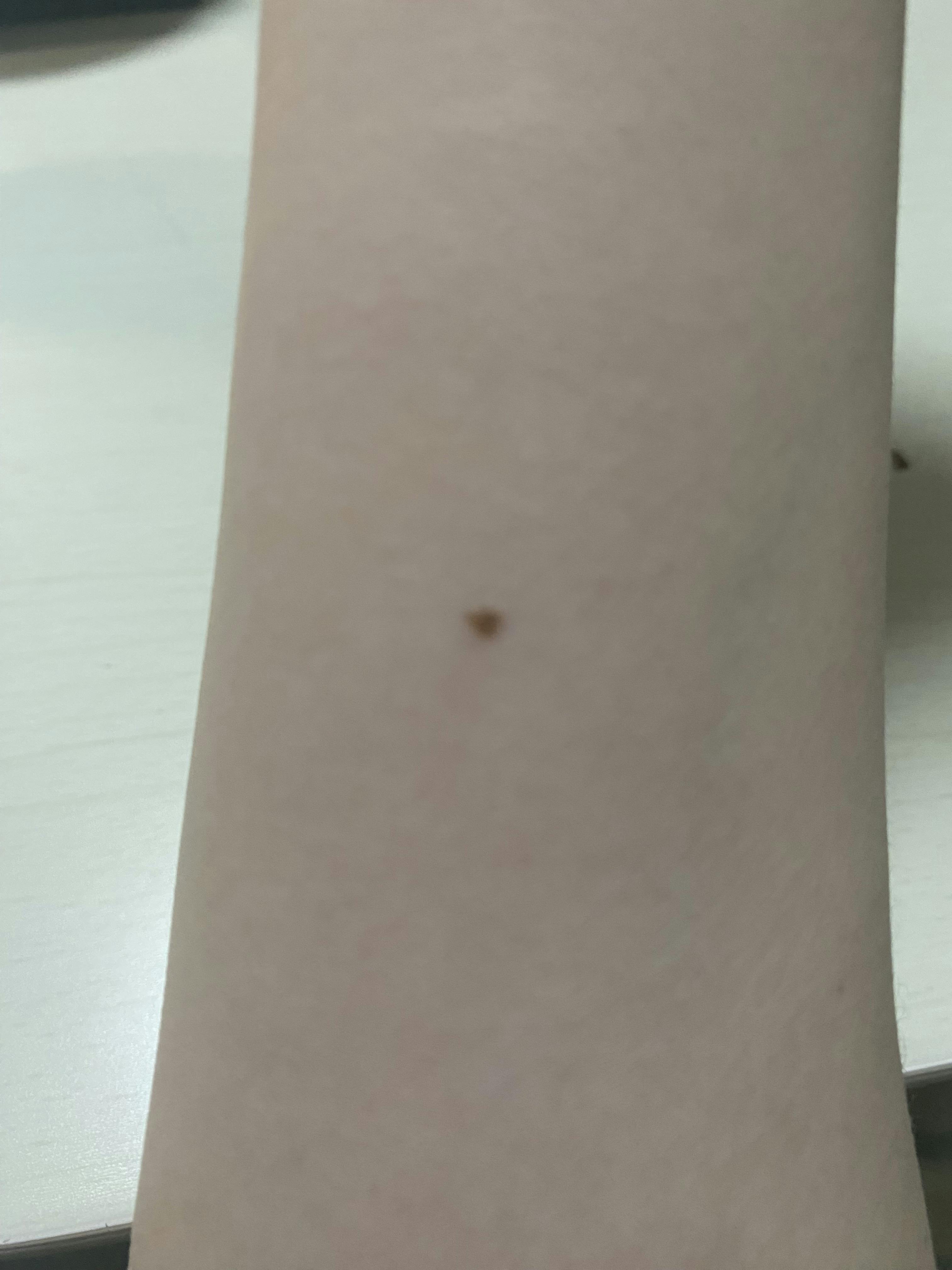 ライズワン美容皮膚科クリニックでほくろ・いぼ除去を受けたゆーさんの写真