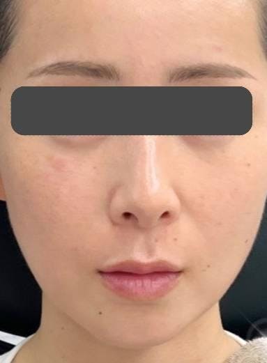 東京美容医療クリニックでエラボトックス・脂肪溶解注射：エラボトックス・脂肪溶解注射を受けたTeTeちゃんさんの写真