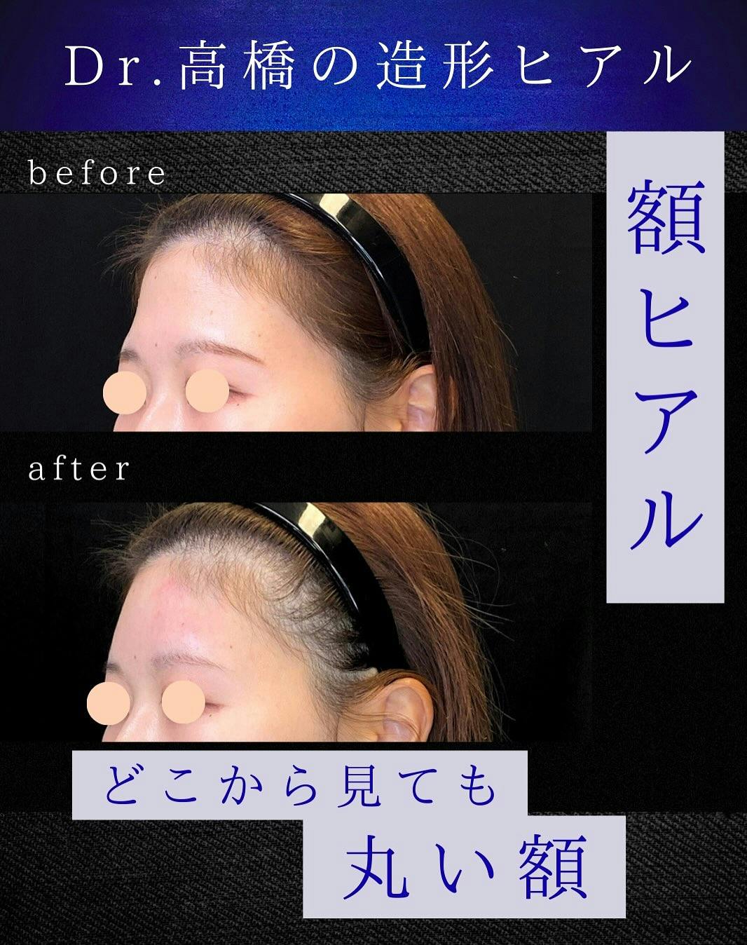 【女性・額】額ヒアル_before_aftar