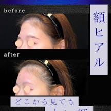 【女性・額】額ヒアル_before_aftar