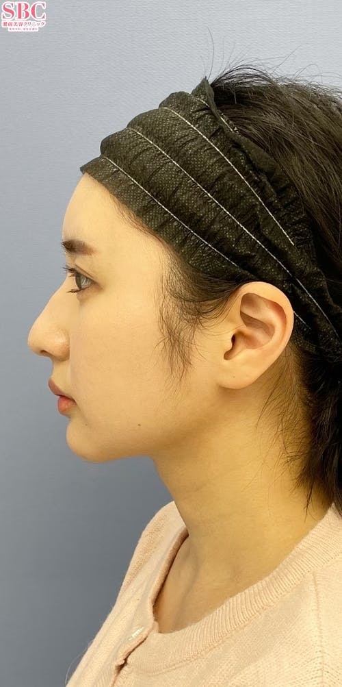 【女性・輪郭】Aquicell（アキーセル）脂肪吸引_aftar