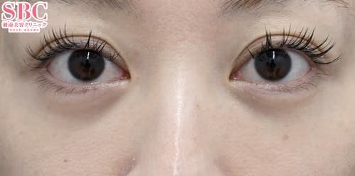 【女性・クマ】目の下の切らないクマ・たるみ（ふくらみ）取り、ナチュラル脂肪注射、VOV（ボブ）リフト_after