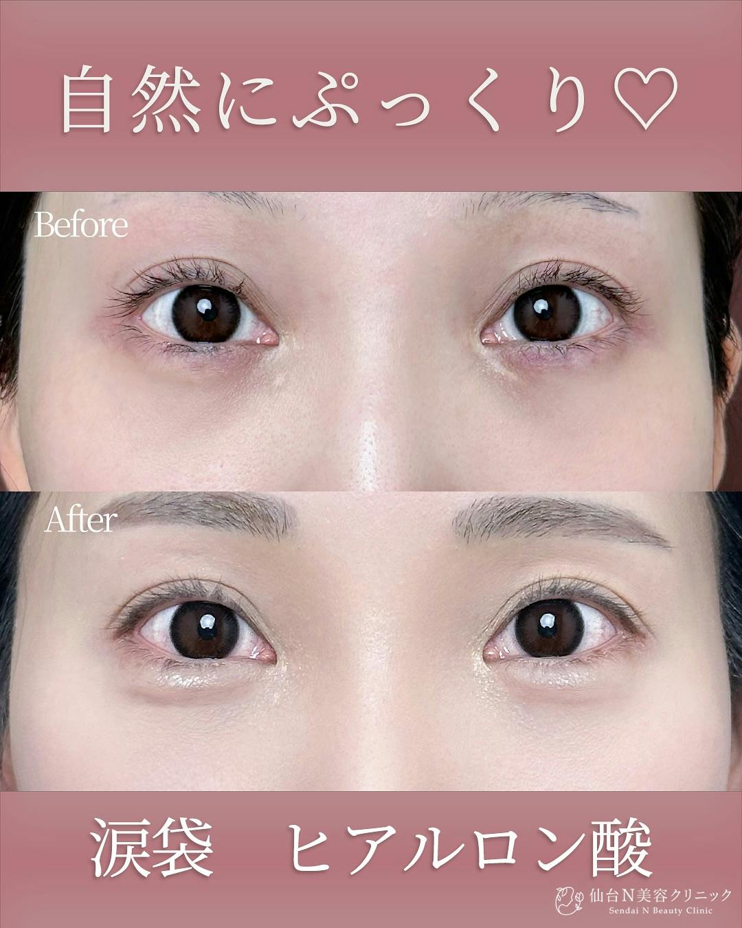 【女性・涙袋】ヒアルロン酸 ボルベラ_before_aftar