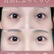 【女性・涙袋】ヒアルロン酸 ボルベラ_before_aftar