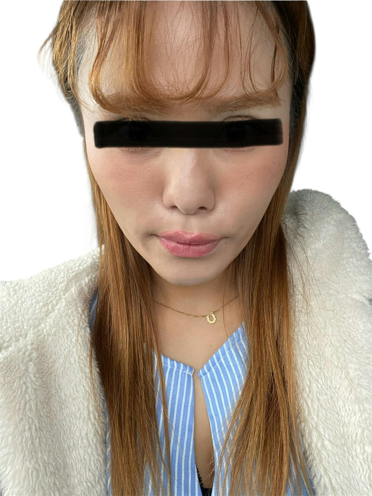 湘南美容クリニック 札幌院で糸リフト(スレッドリフト)・糸リフト(スレッドリフト)を受けたりりさんの写真