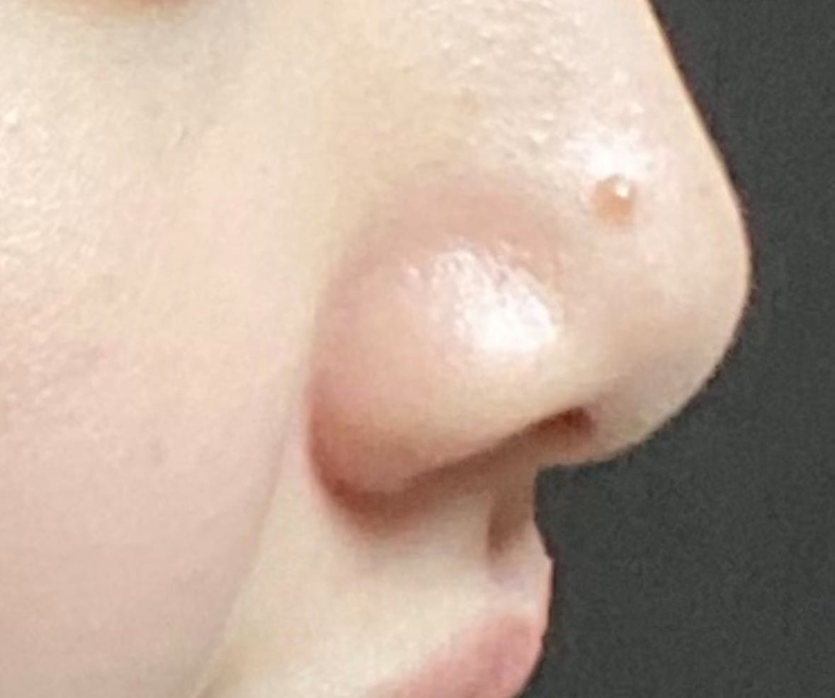 緑の森皮フ科クリニックでほくろ除去を受けたもぐもぐさんの写真
