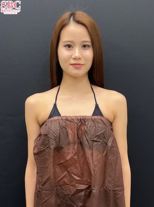 【女性・二の腕】Aquicell（アキーセル）脂肪吸引_aftar