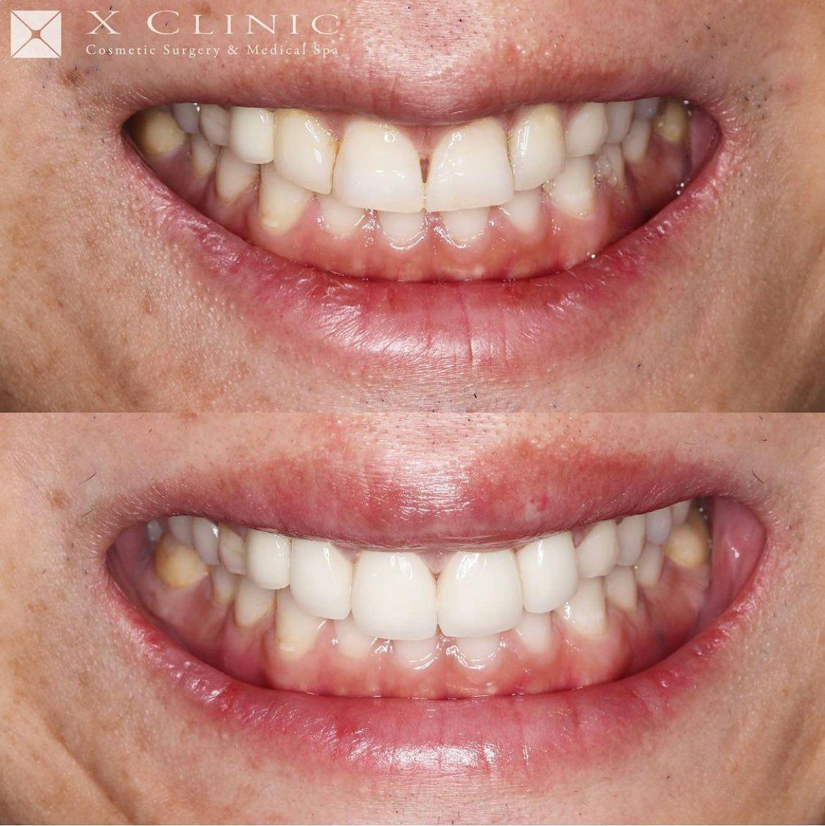 【歯】1dayスピードセラミック 矯正_before_aftar