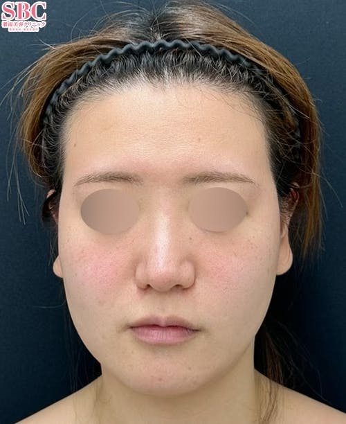 【20代女性・顔】小顔用脂肪吸引注射・エンブレイスRF・糸リフト_before